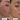 What Is Melasma? A Complete Guide to Understanding This Chronic Pigmentation Condition