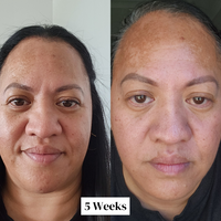 12 Week Hyperpigmentation Kit