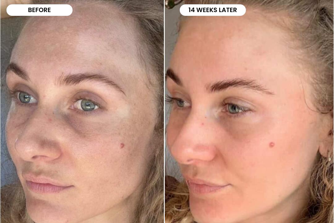 Ashleigh before and after using The Melasma System, 14 week result