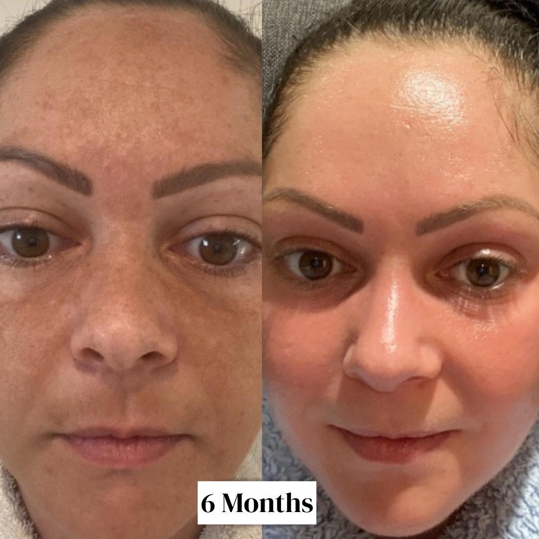 12 Week Hyperpigmentation Kit