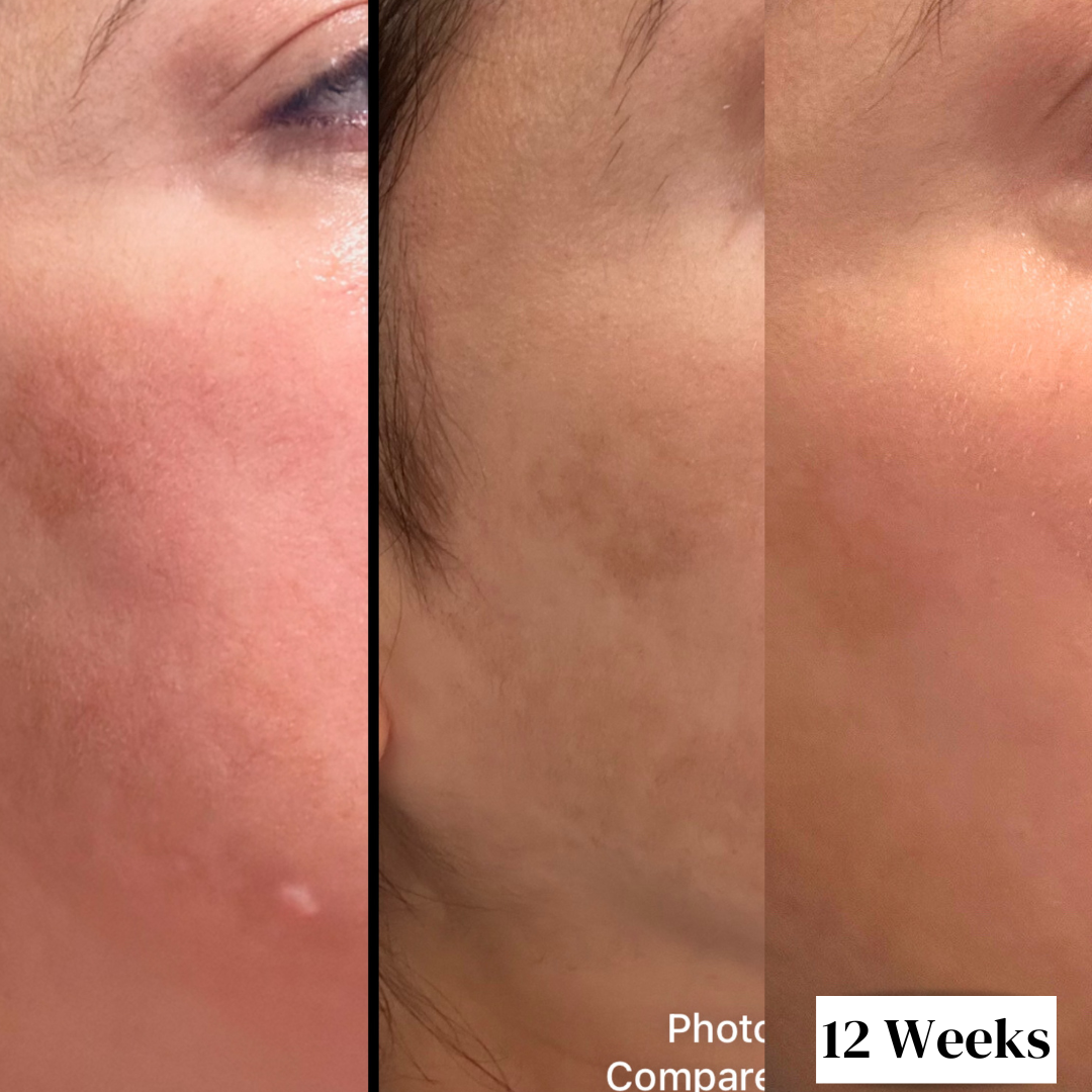 12 Week Hyperpigmentation Kit