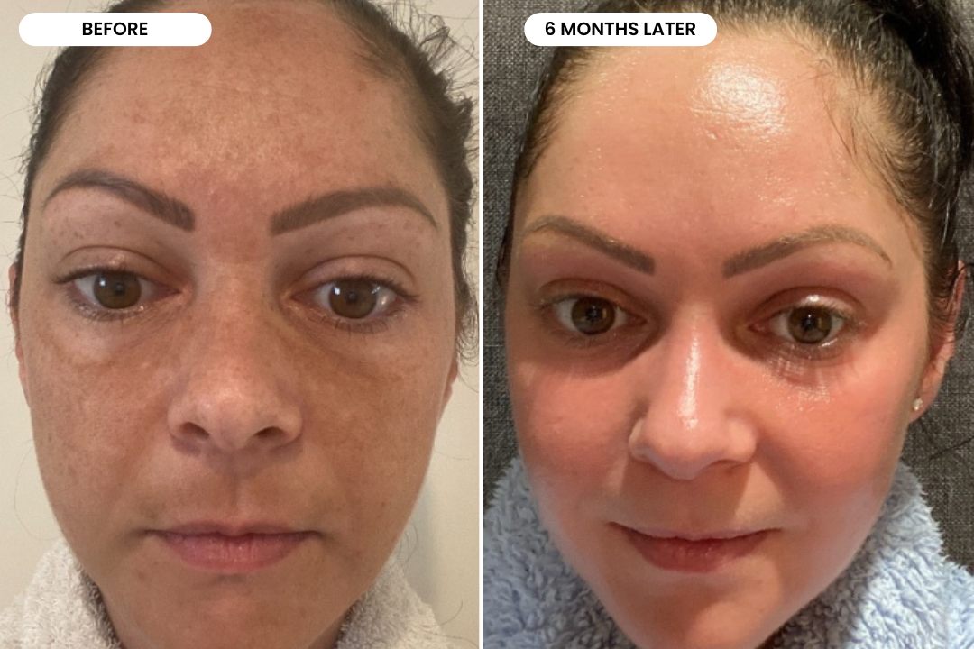 Bianka before and after using The Melasma System, 6 month result