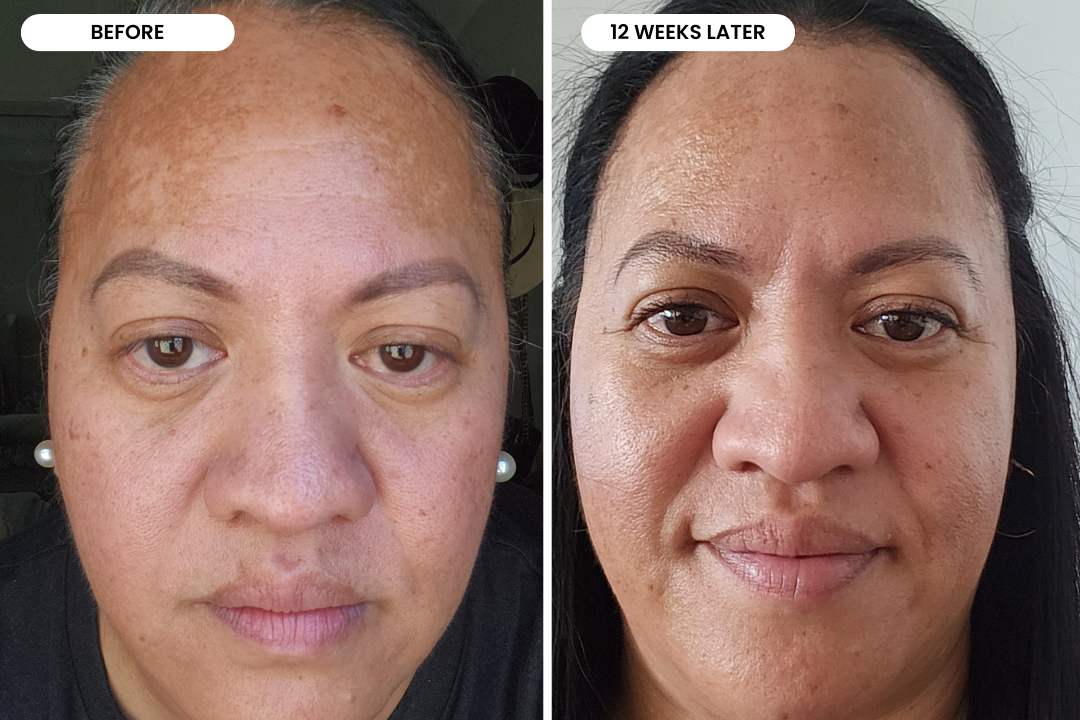 Christina before and after using The Melasma System, 12 week result