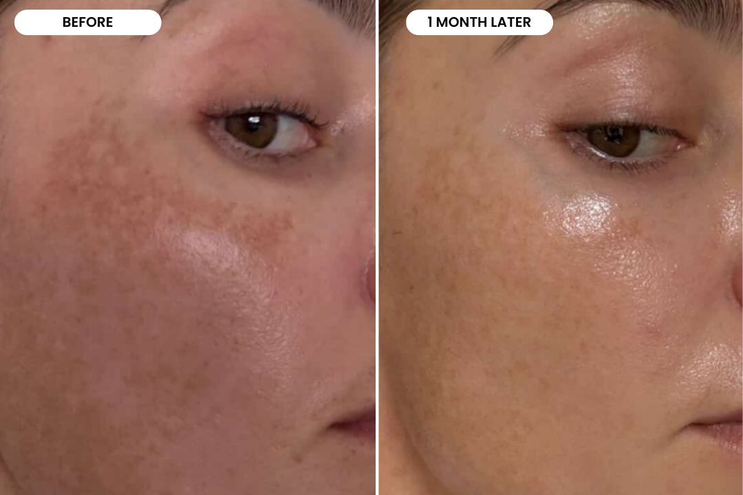 Jessica before and after using The Melasma System, 1 month result