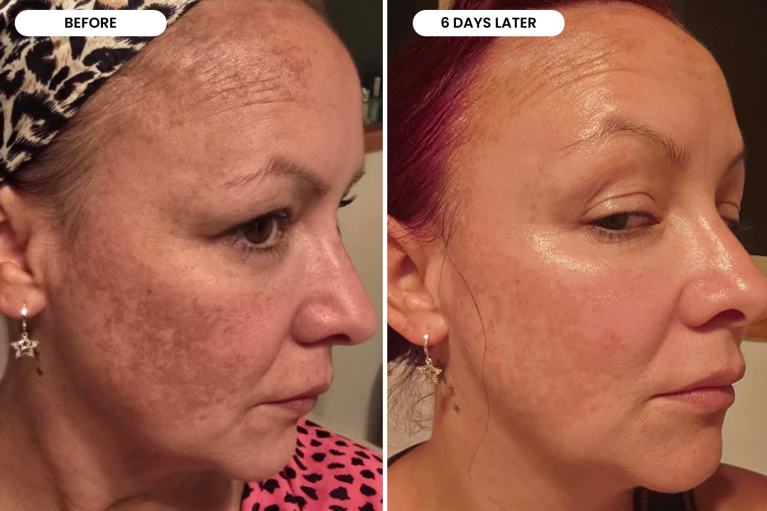Ramona before and after using The Melasma System, 6 day result