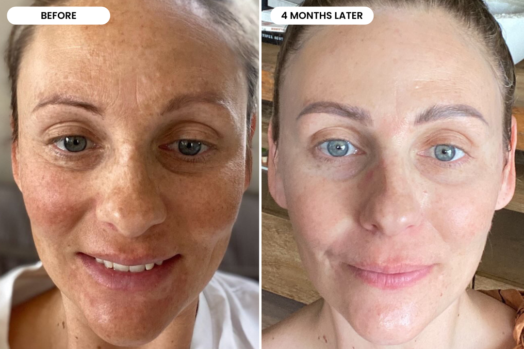 Shannon before and after using The Melasma System, 4 month results