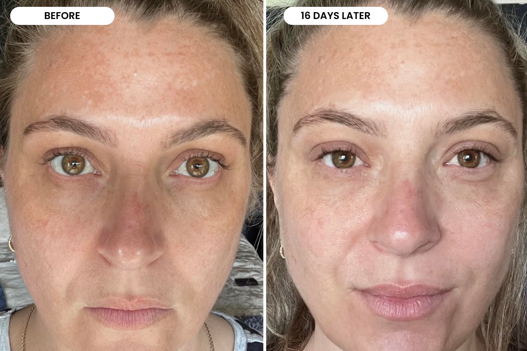 Danielle before and after using The Melasma System, 16 day result