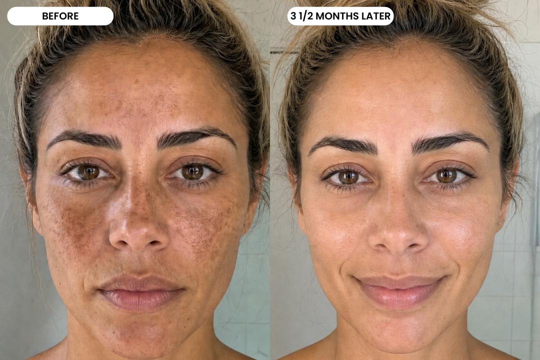 Before and after result using the Windyigarn Melasma Reset System