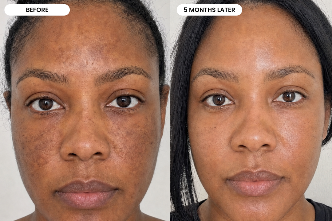 Before and after result using the Windyigarn Melasma Reset System