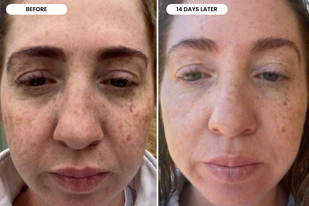 Stacey before and after using The Melasma System, 14 day result